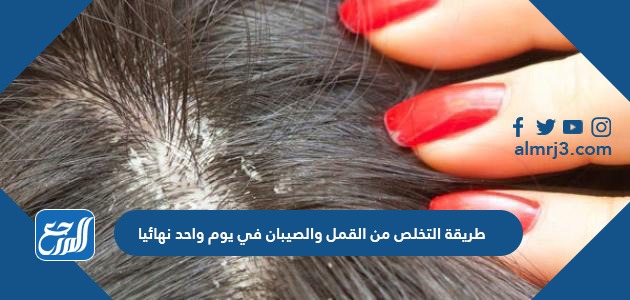 طريقة التخلص من القمل والصيبان في يوم واحد نهائيا