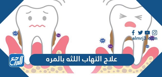 علاج التهاب اللثه بالمره