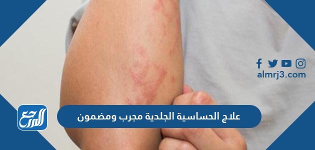 علاج الحساسية الجلدية مجرب ومضمون