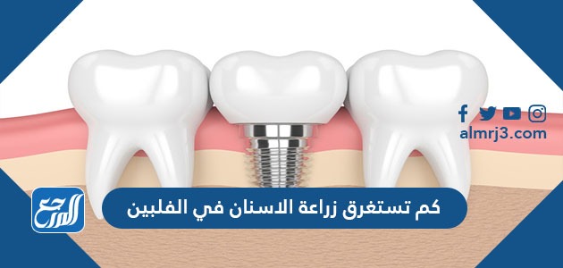 كم تستغرق زراعة الأسنان في الفلبين