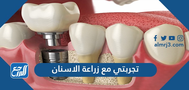 تجربتي مع زراعة الاسنان
