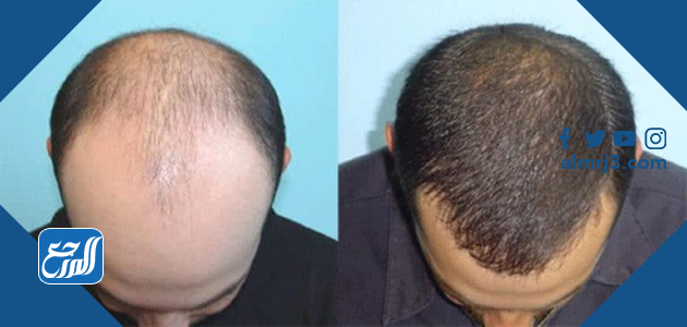 سعر بخاخ minoxidil في السعودية