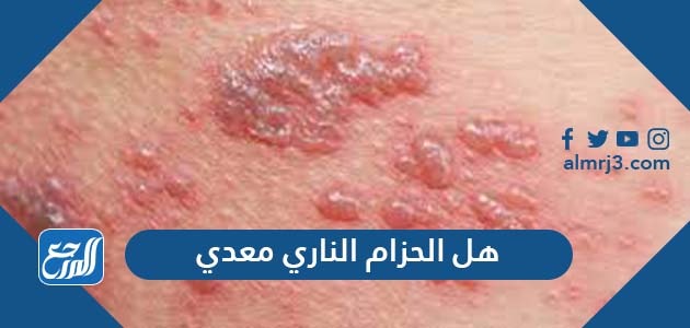 هل الحزام الناري معدي