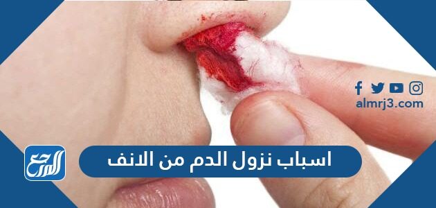 اسباب نزول الدم من الانف