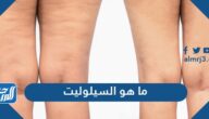 ما هو السيلوليت وما هي اسبابه ومراحله وطرق علاجه