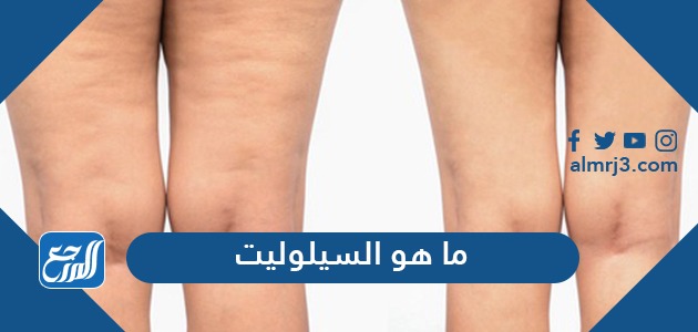 ما هو السيلوليت