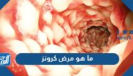 ما هو مرض كرونز وما اسبابه واعراضه وطرق علاجه والوقاية منه