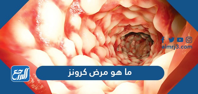 ما هو مرض كرونز