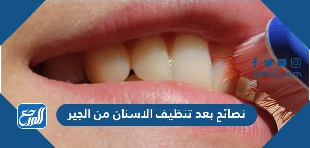 نصائح بعد تنظيف الاسنان من الجير