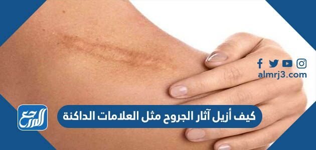 كيف أزيل آثار الجروح مثل العلامات الداكنة