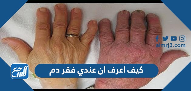 كيف اعرف ان عندي فقر دم