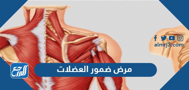 مرض ضمور العضلات