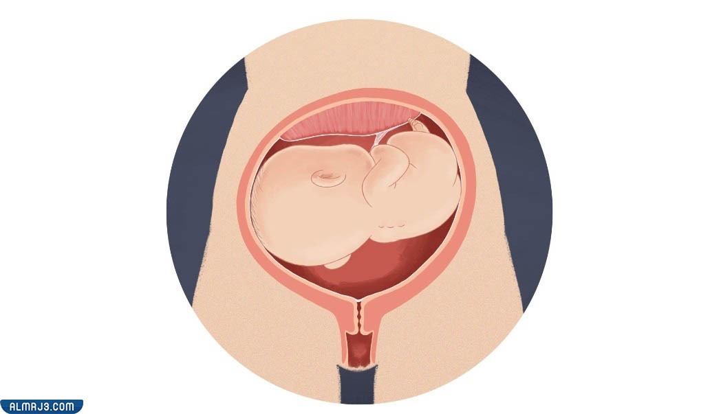 الوضع العرضي للجنين في بطن الأم