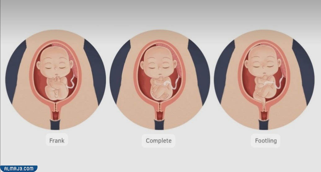 وضعية المقعد الخلفي للجنين في بطن الأم