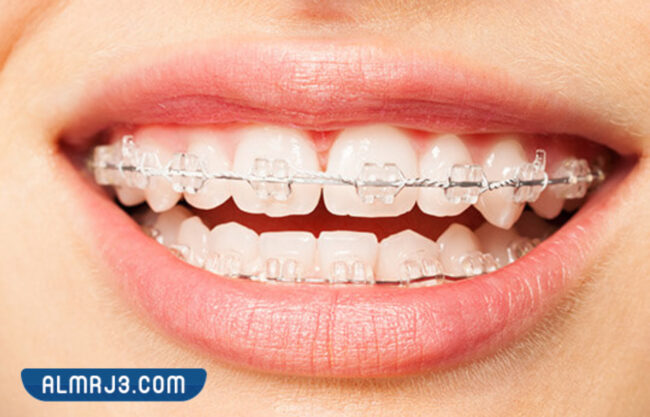 dental ceramic braces