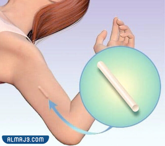طريقة تركيب كبسولة منع الحمل