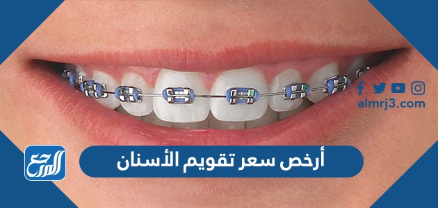 أرخص سعر تقويم الأسنان 2021