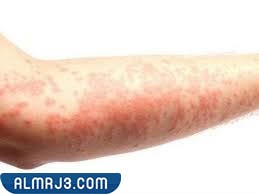 أعراض الحكة