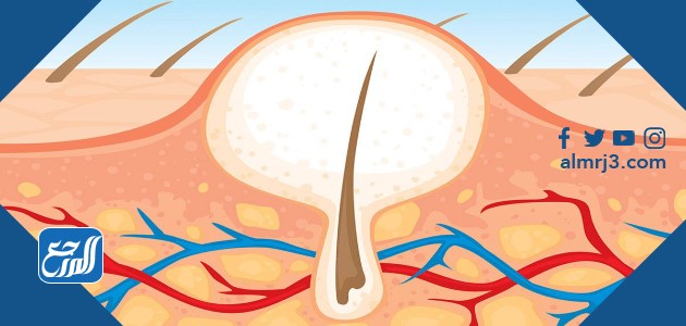 ازالة الشعر