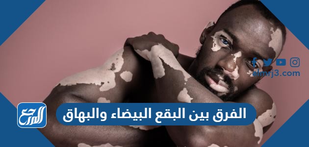 الفرق بين البقع البيضاء والبهاق