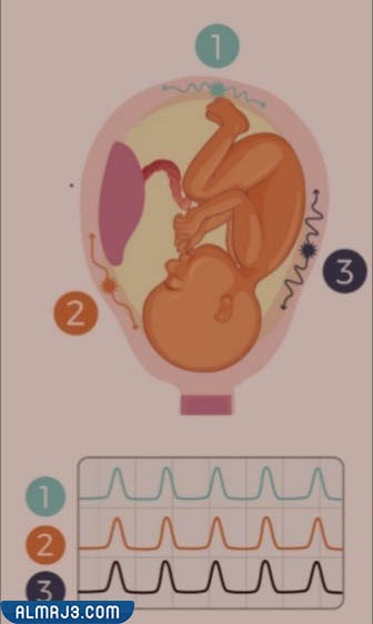 الفرق بين تحجر البطن والمخاض الحقيقي - المخاض الحقيقي