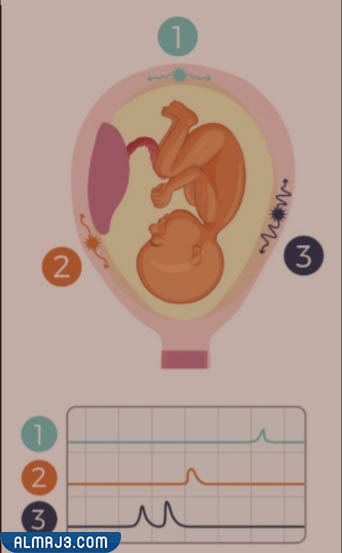 الفرق بين تحجر البطن والمخاض الحقيقي - المخاض الكاذب
