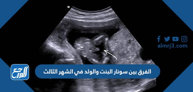 الفرق بين سونار البنت والولد في الشهر الثالث