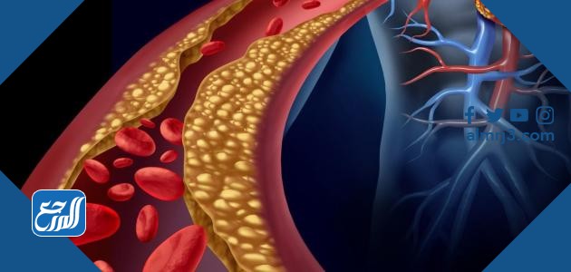 الكوليسترول الضار