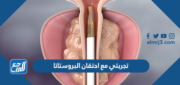 تجربتي مع احتقان البروستاتا