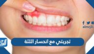 تجربتي مع انحسار اللثة وأعراضها وطرق علاجها بالوصفات الطبيعية