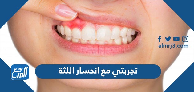 تجربتي مع انحسار اللثة