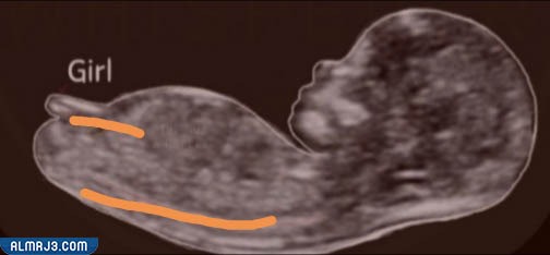 سونار البنت في الشهر الثالث
