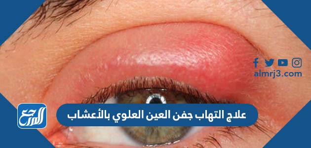 علاج التهاب جفن العين العلوي بالأعشاب