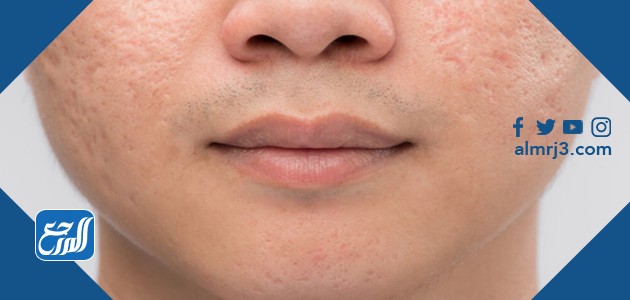 علاج ندوب الوجه
