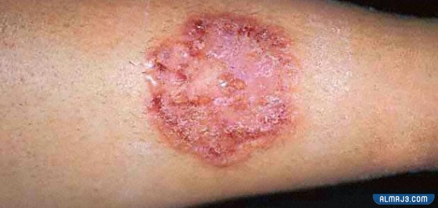 كيفية علاج الإنسان من فطريات القطط