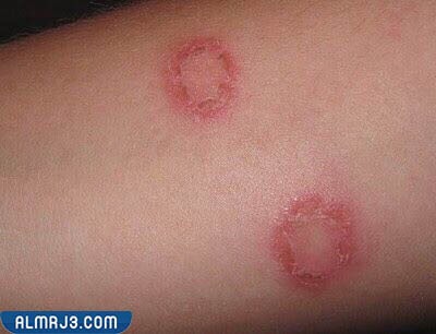 مراحل ظهور فطريات القطط عند الإنسان