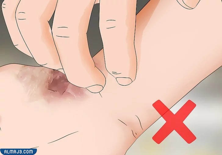 صب الماء البارد على الحروق