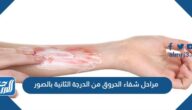مراحل شفاء الحروق من الدرجة الثانية بالصور