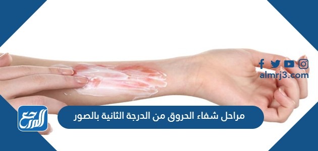 مراحل شفاء الحروق من الدرجة الثانية بالصور