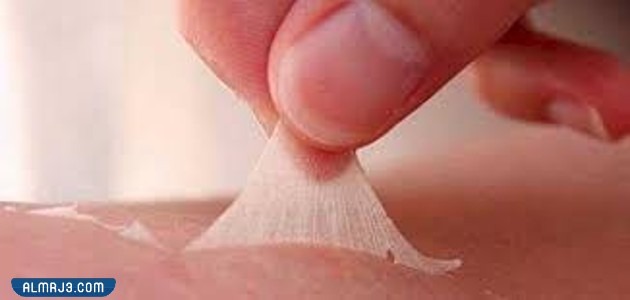 مراحل شفاء الحروق من الدرجة الثانية بالصور