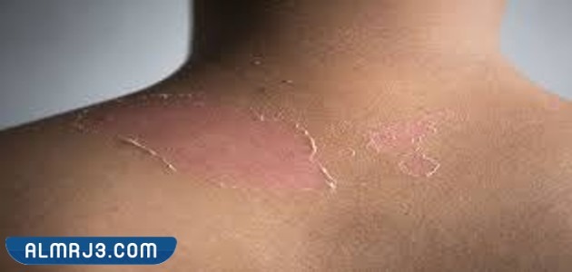 مراحل شفاء الحروق من الدرجة الثانية بالصور