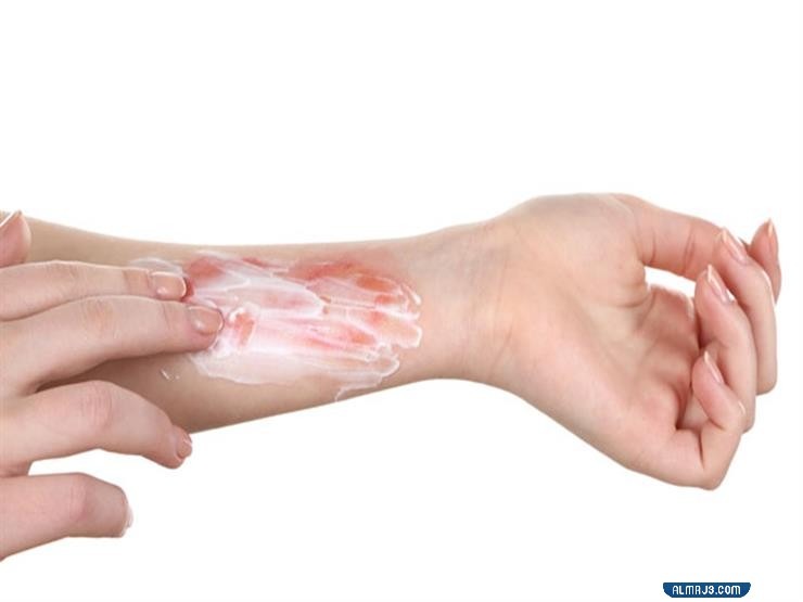 مراحل شفاء الحروق من الدرجة الثانية بالصور