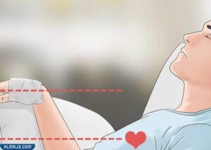 مراحل شفاء الحروق من الدرجة الثانية بالصور