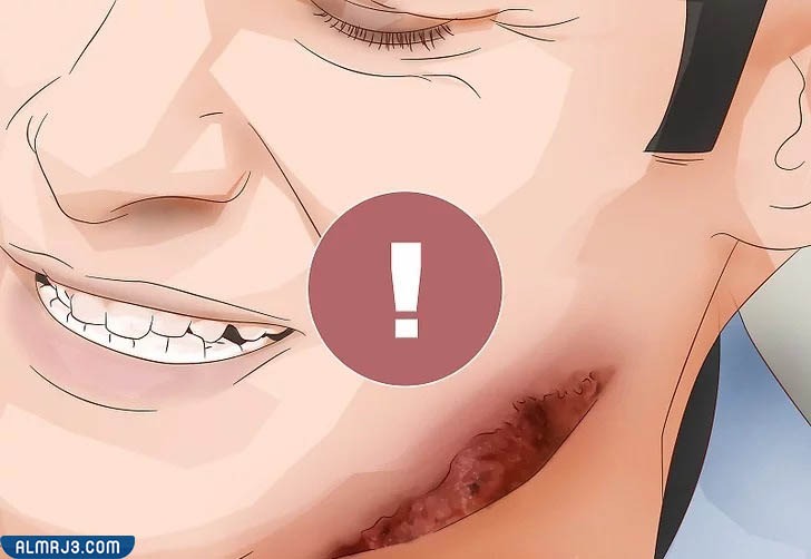 مراحل شفاء الحروق من الدرجة الثانية بالصور