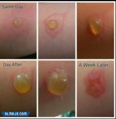 مراحل شفاء الحروق من الدرجة الثانية بالصور