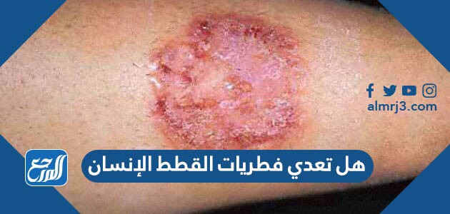 هل تعدي فطريات القطط الإنسان