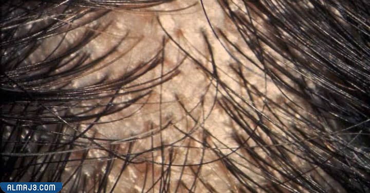 أسباب الاصابة بفراغات الشعر