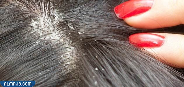 علاج القمل باستخدام مجفف الشعر