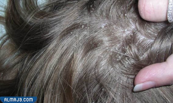 تشخيص القمل