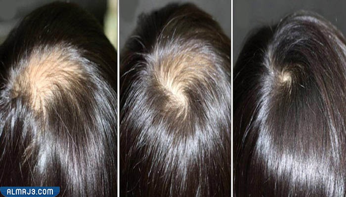 الثعلبة وفراغات الشعر عند الاطفال